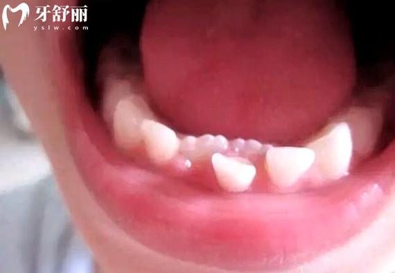 兒童乳牙滯留怎么處理