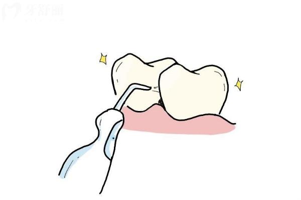 牙醫(yī)為什么推薦用沖牙器？做到清潔到位才可以保護(hù)口腔
