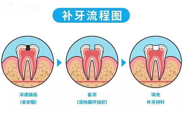 補牙流程圖
