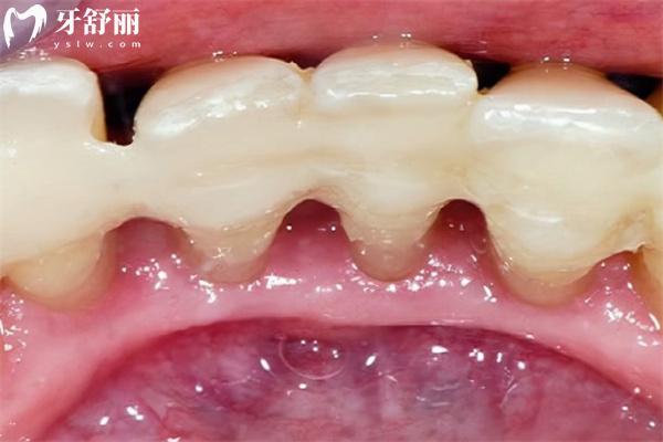 牙齒松動(dòng)固定圖片