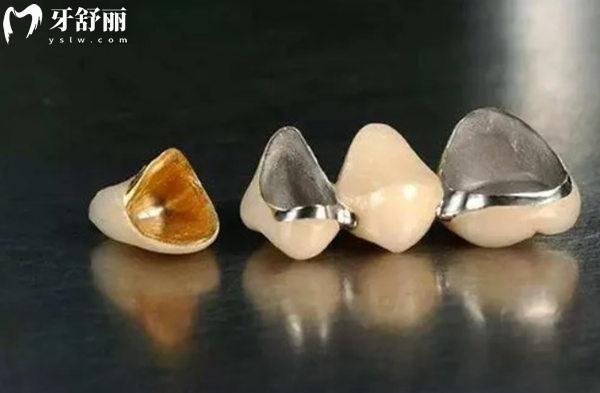 鑲牙的使用壽命一般是多久