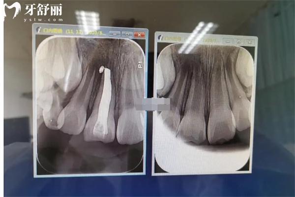 牙尖誘導成形術