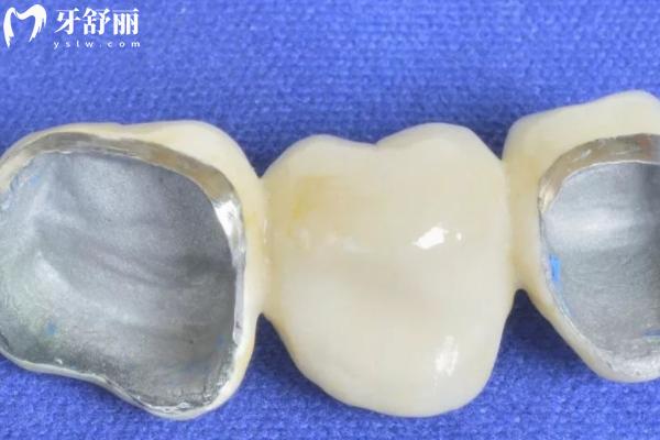 30歲做了滿口烤瓷牙能用一輩子嗎