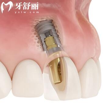 哈爾濱醫(yī)大**種植牙多少錢?一顆2880+半口1.6萬全口費(fèi)用明細(xì)公開