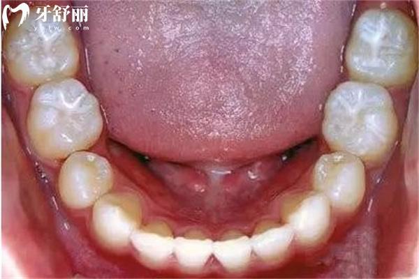 兒童六齡牙窩溝封閉
