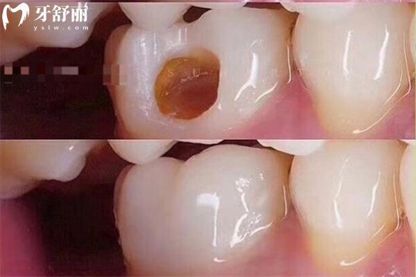 兒童六齡牙做窩溝封閉