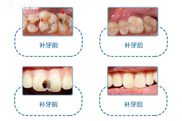 齲齒一度到五度的癥狀是什么