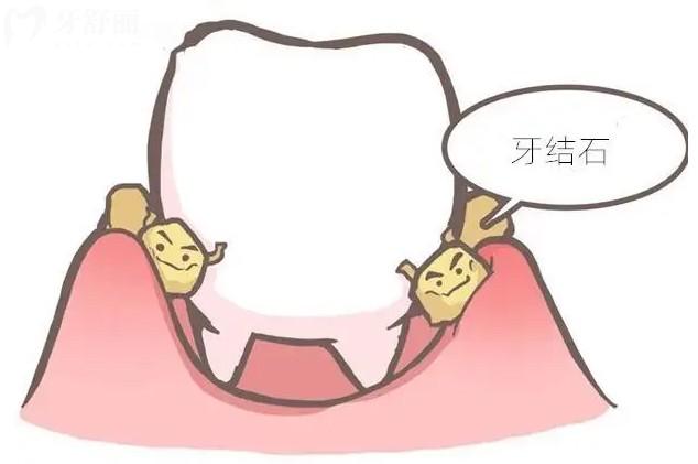 牙結(jié)石
