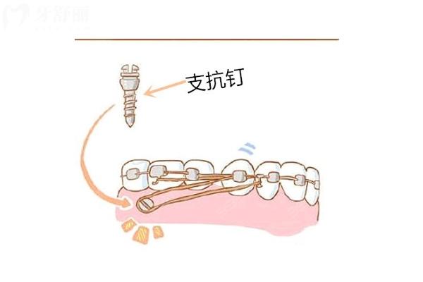 牙齒矯正為什么要打骨釘？因人而異，不是每個(gè)人都需要