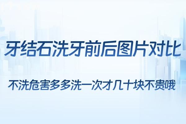 牙結(jié)石洗牙前后圖片對比:不洗危害多多洗一次才幾十塊不貴哦!