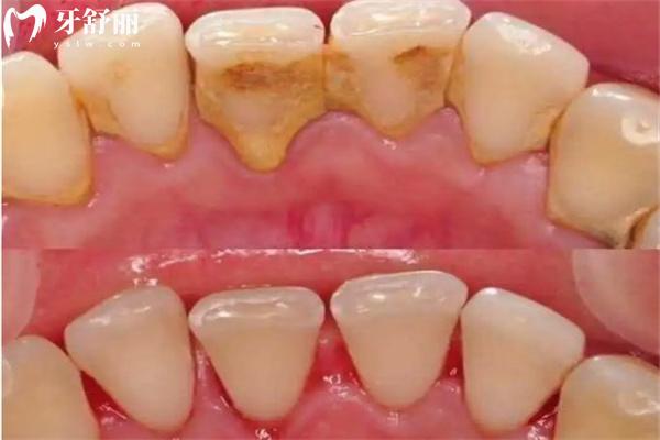 牙結(jié)石洗牙前后圖片對比