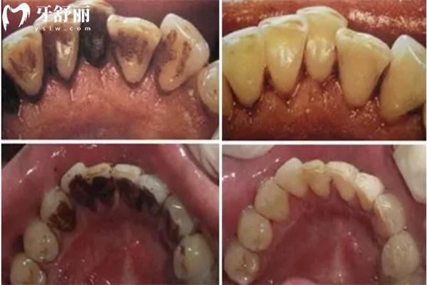 牙結(jié)石洗牙前后圖片對比