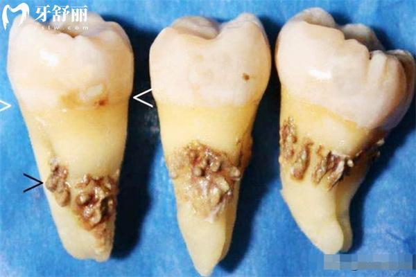 牙結(jié)石洗牙前后圖片對比