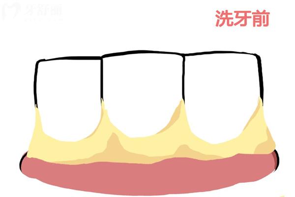 牙結(jié)石洗牙前后圖片對比