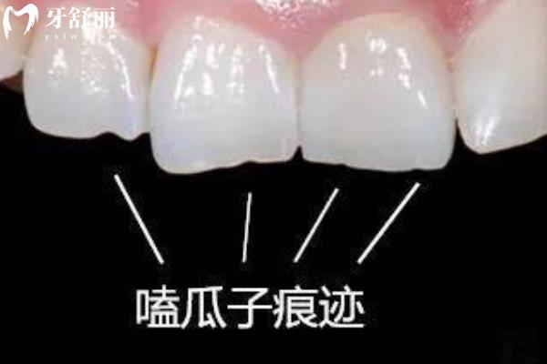 瓜子牙的傷害