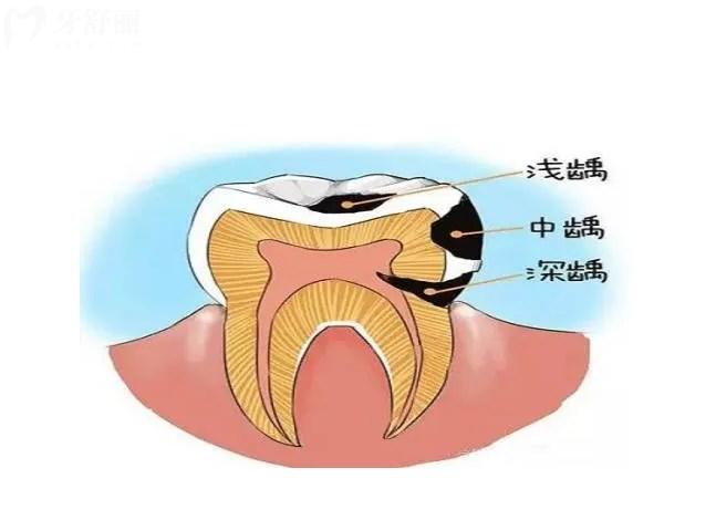 每天都有好好刷牙，為什么還會蛀牙呢