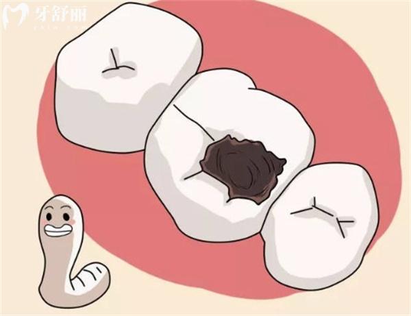 蛀牙后應(yīng)該如何處理