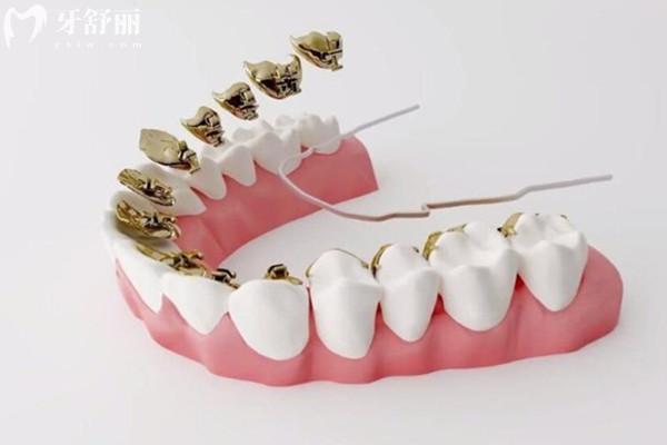 矯正牙齒骨釘可以做核磁嗎