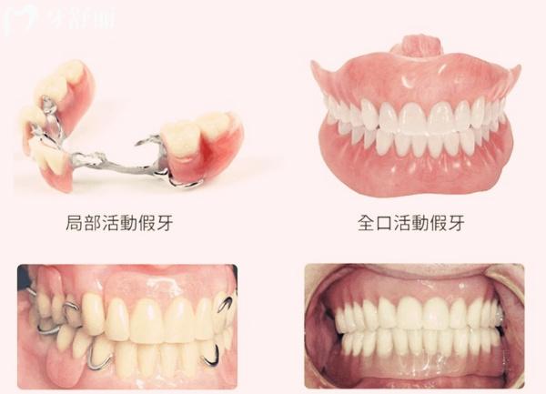 鑲半口牙用什么材質(zhì)比較便宜而又適宜