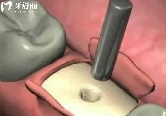 種牙攻略大集合！常見疑惑解析，讓你少走彎路