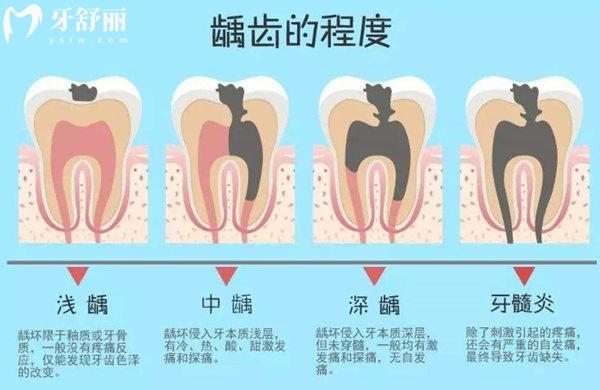 齲齒的病變的過程