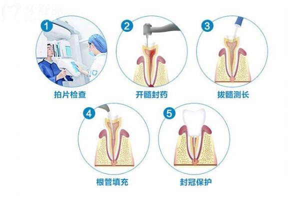 根管治療vs拔牙種植該怎么選？詳細(xì)講述兩者適應(yīng)癥