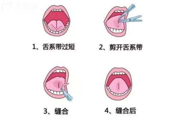 舌系帶矯正術(shù)
