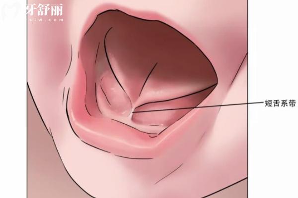 舌系帶矯正術(shù)