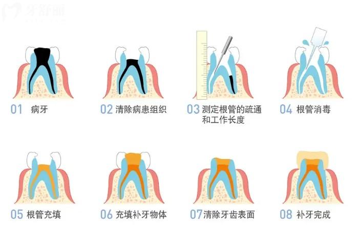 根管治療的過程