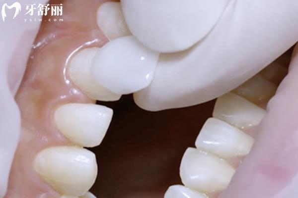 氟斑牙能洗掉嗎？