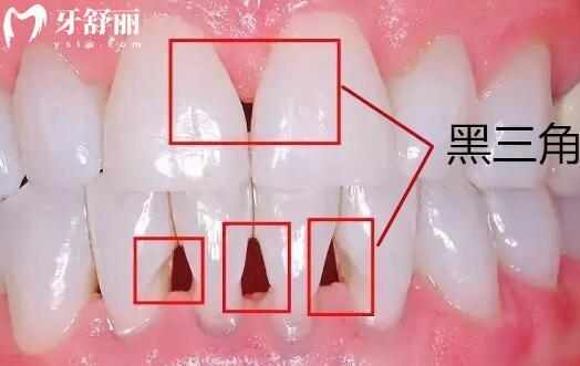 牙齒上的黑三角是怎么回事?可以補(bǔ)救嗎?