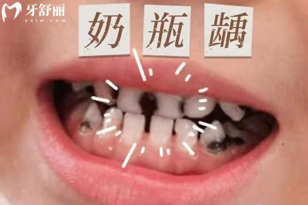奶瓶齲齒怎么形成的
