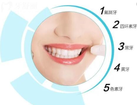 牙齒美白秘籍科普:皓齒美白多久做第二次結(jié)果好?把握美白黃金時機(jī)