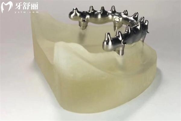 種植牙純鈦橋架哪個(gè)品牌好