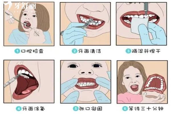 牙齒涂氟過程