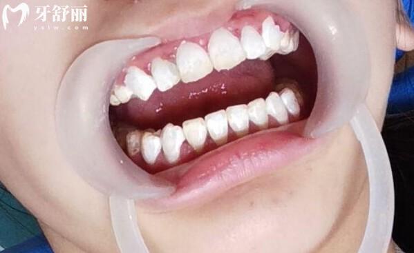 氟斑牙較好的治療方法有哪些