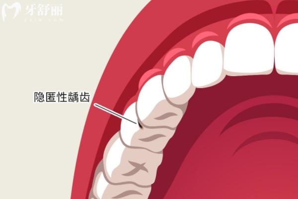 牙沒壞但是冷熱刺激疼？