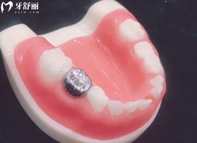 乳牙預(yù)成冠的作用