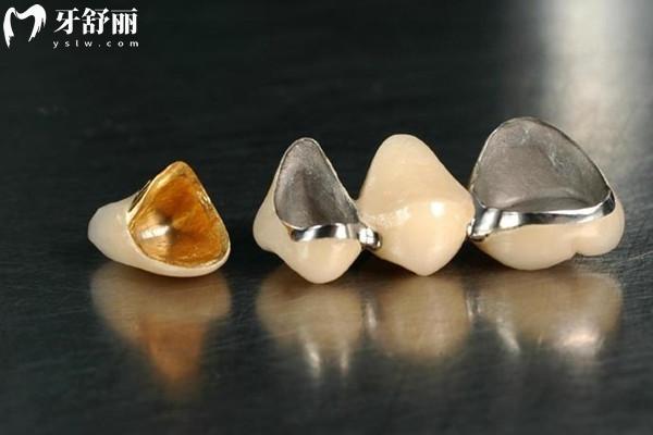 鑲一顆牙能維持多久