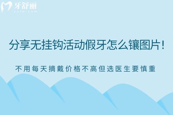 分享無掛鉤活動假牙怎么鑲圖片!不用每天摘戴價格不高但選醫(yī)生要慎重