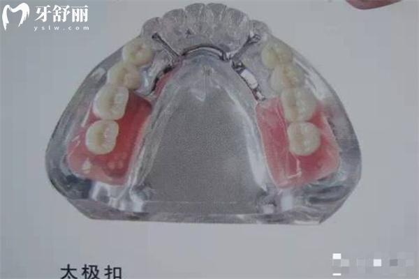 無掛鉤活動假牙