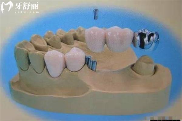 無掛鉤活動假牙怎么鑲圖片