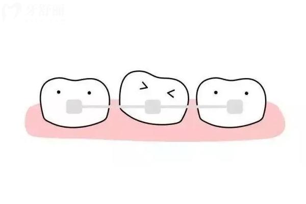 牙齒矯正需要兩年時(shí)間？有沒有時(shí)間短的矯正方式？