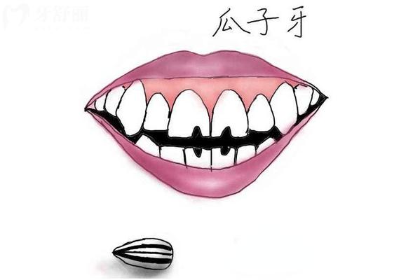 什么是瓜子牙