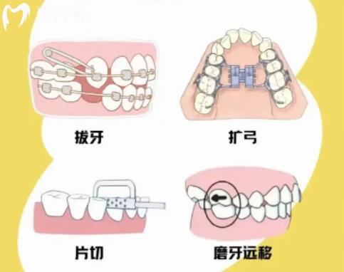正畸治療中的推磨是什么?推磨牙后移好還是拔正畸牙好？