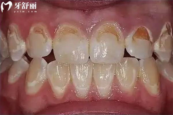 牙齒門縫大怎么辦?