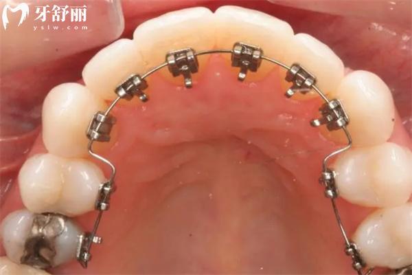 牙齒門縫大怎么辦?
