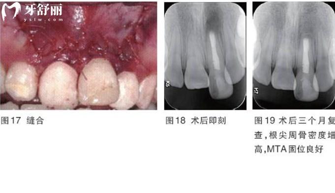 根尖切除