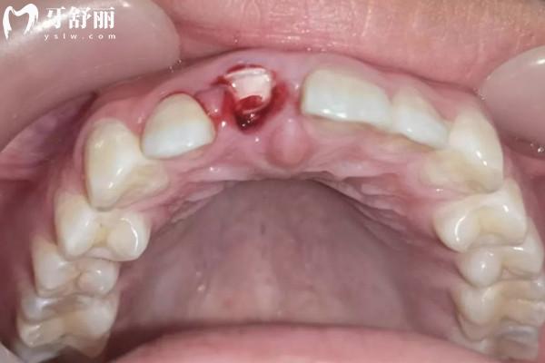 牙齒斷了不去處理的后果