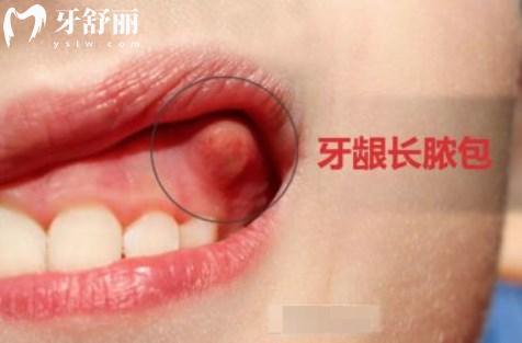 牙齦長膿包圖片大全